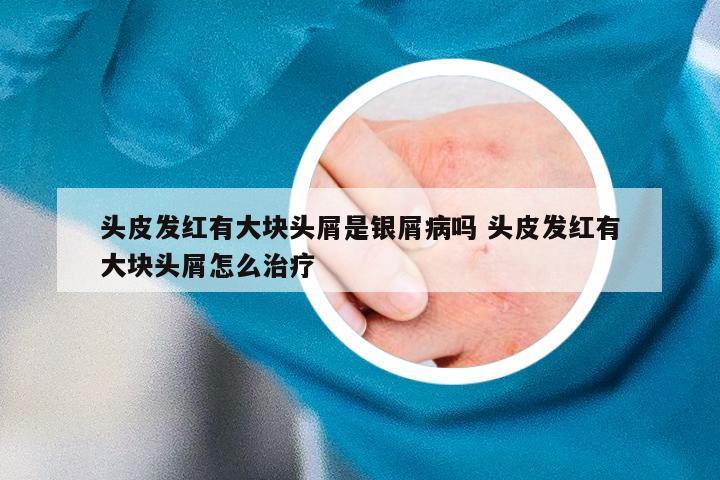 头皮发红有大块头屑是银屑病吗 头皮发红有大块头屑怎么治疗