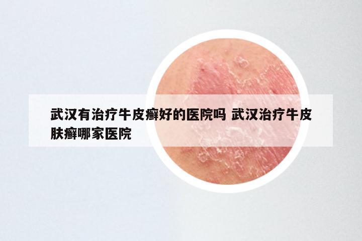 武汉有治疗牛皮癣好的医院吗 武汉治疗牛皮肤癣哪家医院