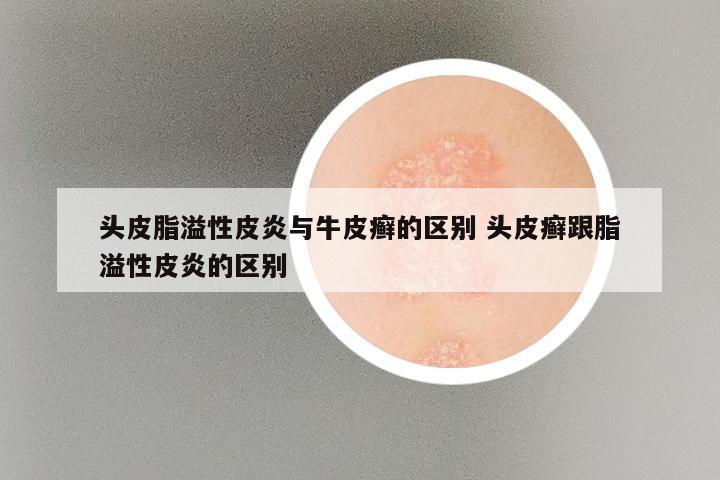 头皮脂溢性皮炎与牛皮癣的区别 头皮癣跟脂溢性皮炎的区别