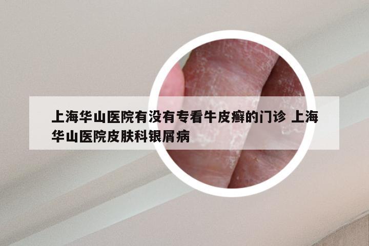 上海华山医院有没有专看牛皮癣的门诊 上海华山医院皮肤科银屑病