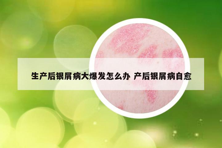 生产后银屑病大爆发怎么办 产后银屑病自愈