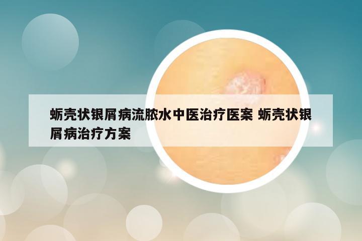蛎壳状银屑病流脓水中医治疗医案 蛎壳状银屑病治疗方案