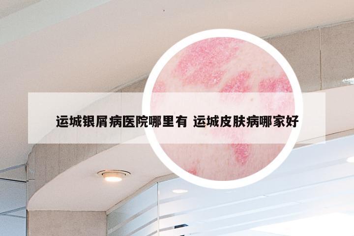 运城银屑病医院哪里有 运城皮肤病哪家好