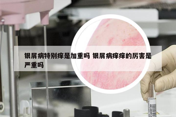 银屑病特别痒是加重吗 银屑病痒痒的厉害是严重吗