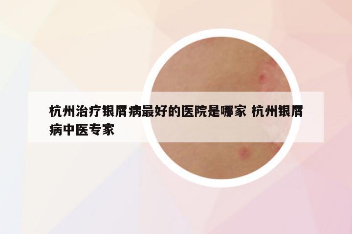 杭州治疗银屑病最好的医院是哪家 杭州银屑病中医专家