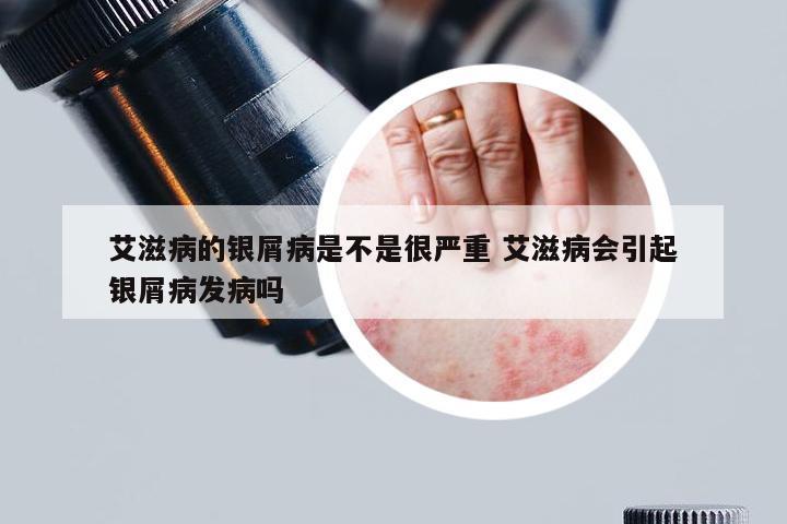 艾滋病的银屑病是不是很严重 艾滋病会引起银屑病发病吗