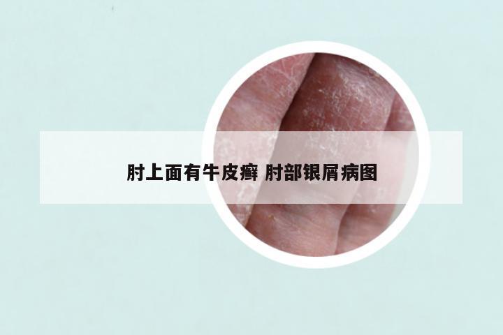 肘上面有牛皮癣 肘部银屑病图