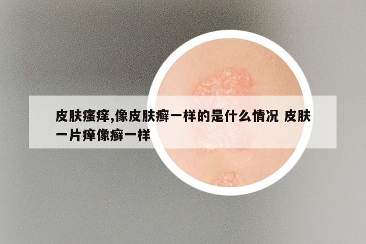 皮肤瘙痒,像皮肤癣一样的是什么情况 皮肤一片痒像癣一样