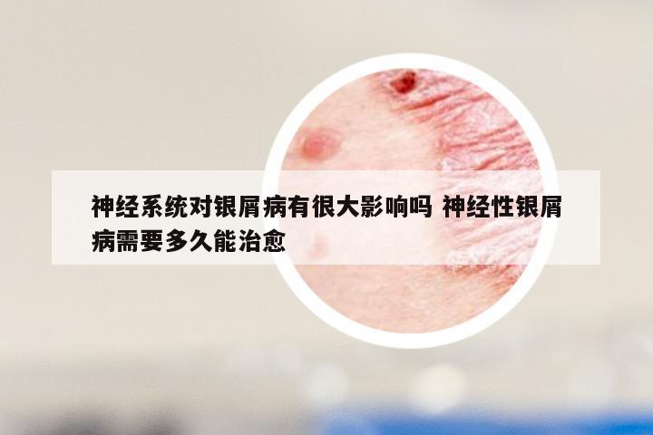 神经系统对银屑病有很大影响吗 神经性银屑病需要多久能治愈