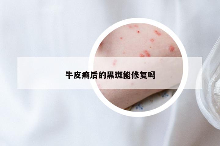 牛皮癣后的黑斑能修复吗