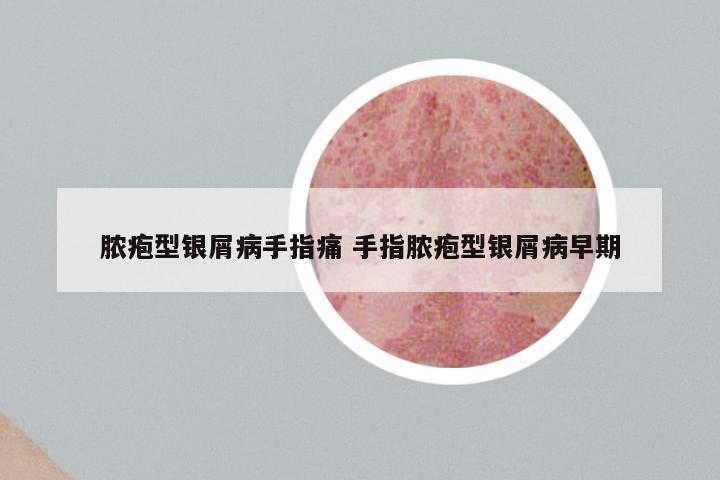 脓疱型银屑病手指痛 手指脓疱型银屑病早期