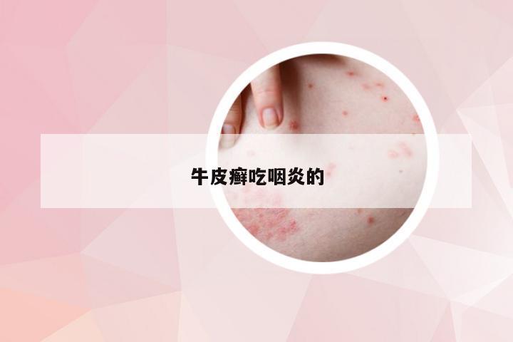 牛皮癣吃咽炎的