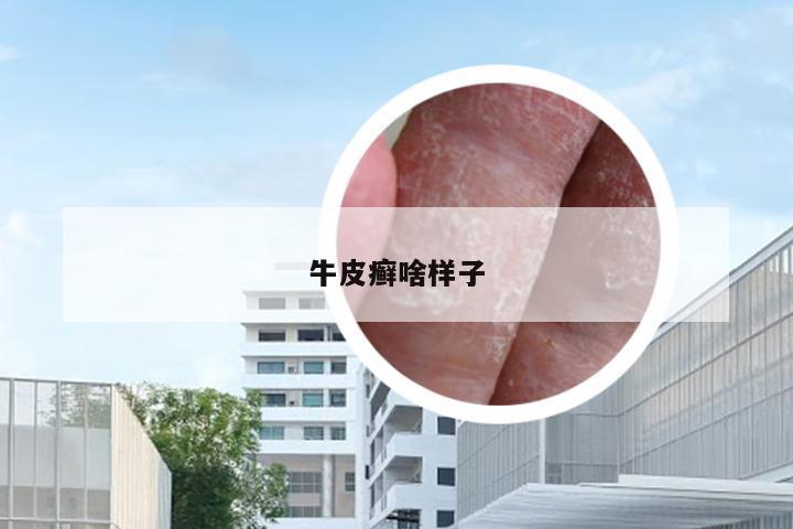 牛皮癣啥样子