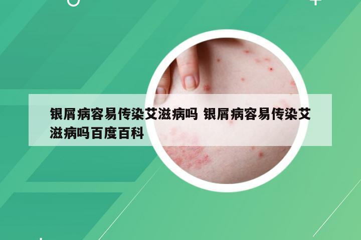 银屑病容易传染艾滋病吗 银屑病容易传染艾滋病吗百度百科