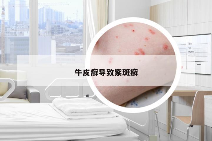 牛皮癣导致紫斑癣