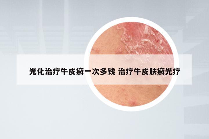 光化治疗牛皮癣一次多钱 治疗牛皮肤癣光疗