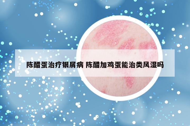 陈醋蛋治疗银屑病 陈醋加鸡蛋能治类风湿吗