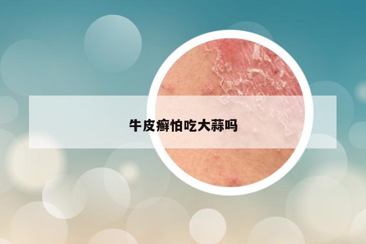 牛皮癣怕吃大蒜吗