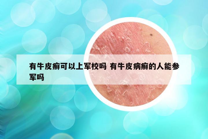 有牛皮癣可以上军校吗 有牛皮病癣的人能参军吗