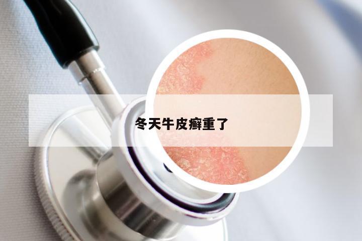 冬天牛皮癣重了