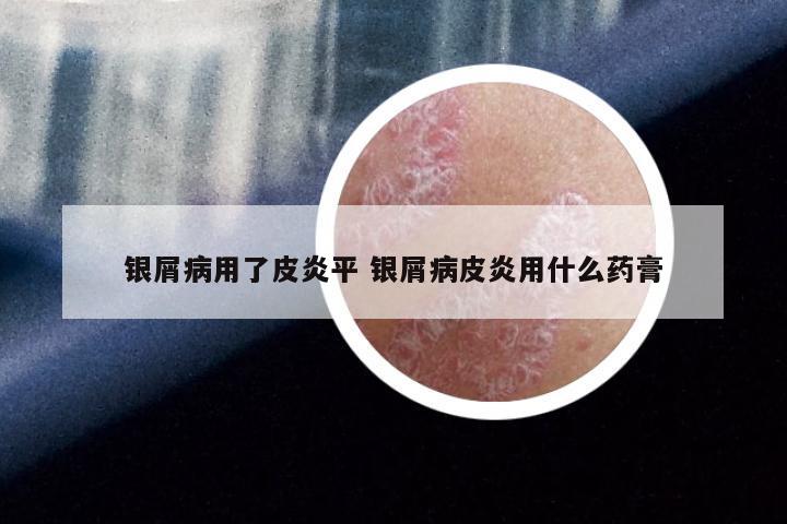 银屑病用了皮炎平 银屑病皮炎用什么药膏