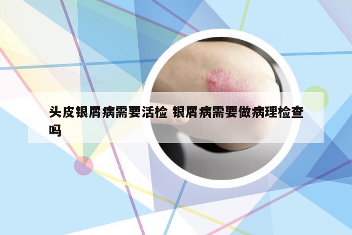 头皮银屑病需要活检 银屑病需要做病理检查吗