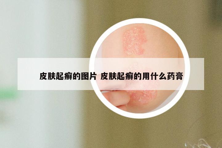 皮肤起癣的图片 皮肤起癣的用什么药膏