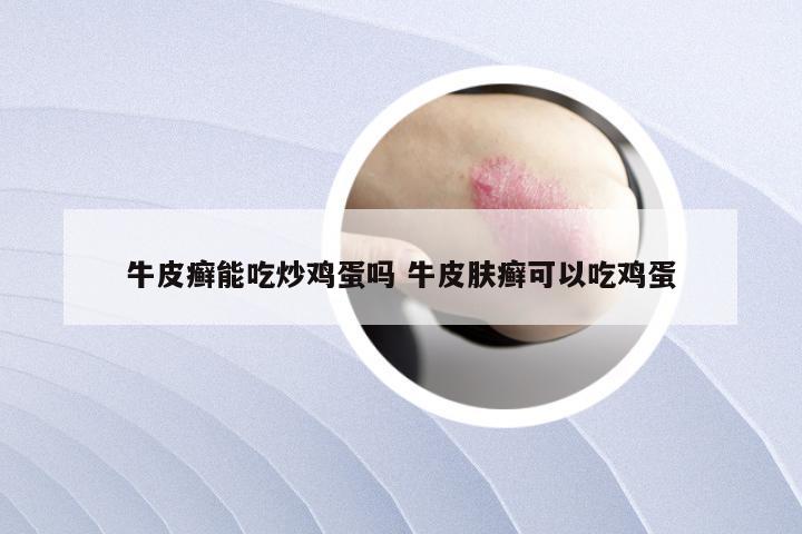 牛皮癣能吃炒鸡蛋吗 牛皮肤癣可以吃鸡蛋