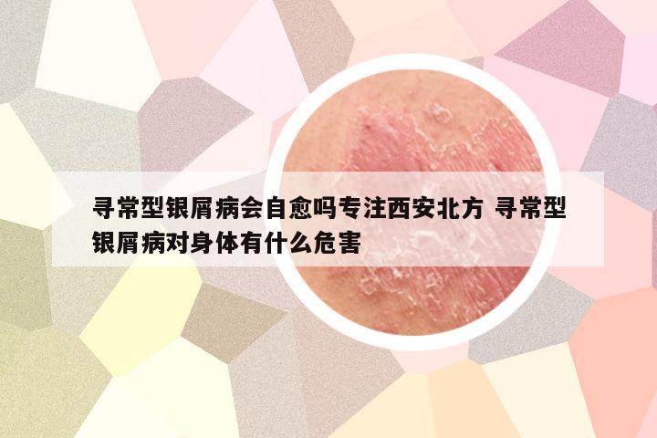 寻常型银屑病会自愈吗专注西安北方 寻常型银屑病对身体有什么危害