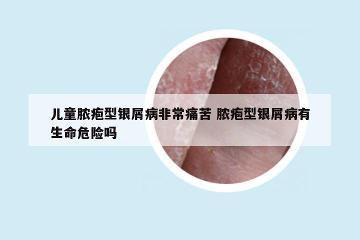 儿童脓疱型银屑病非常痛苦 脓疱型银屑病有生命危险吗