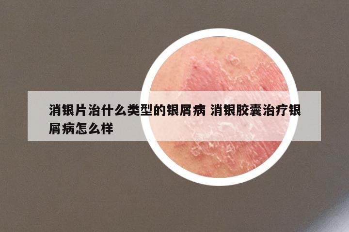 消银片治什么类型的银屑病 消银胶囊治疗银屑病怎么样