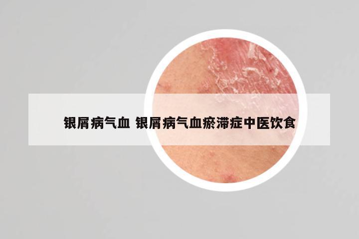 银屑病气血 银屑病气血瘀滞症中医饮食