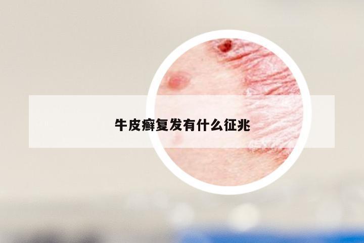 牛皮癣复发有什么征兆