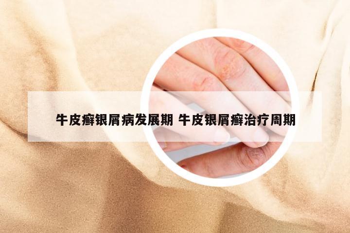 牛皮癣银屑病发展期 牛皮银屑癣治疗周期