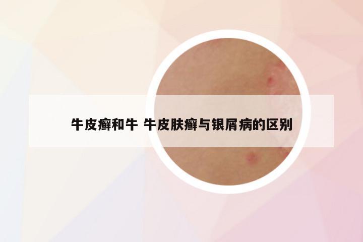 牛皮癣和牛 牛皮肤癣与银屑病的区别
