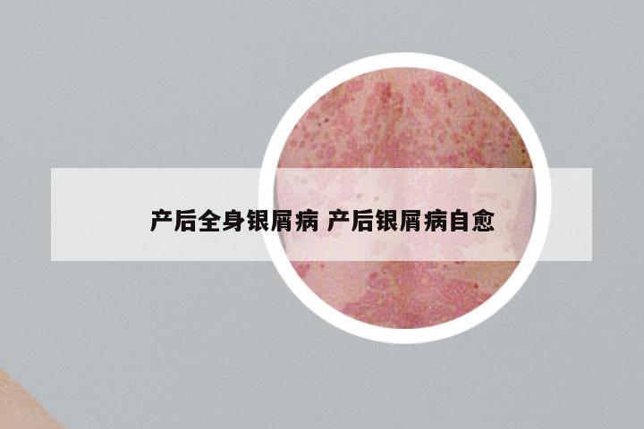 产后全身银屑病 产后银屑病自愈