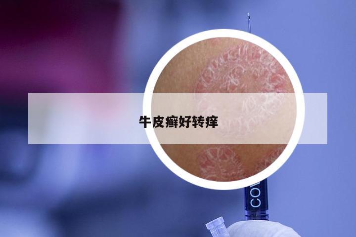 牛皮癣好转痒
