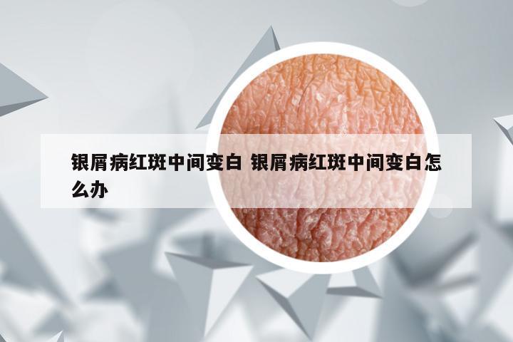 银屑病红斑中间变白 银屑病红斑中间变白怎么办