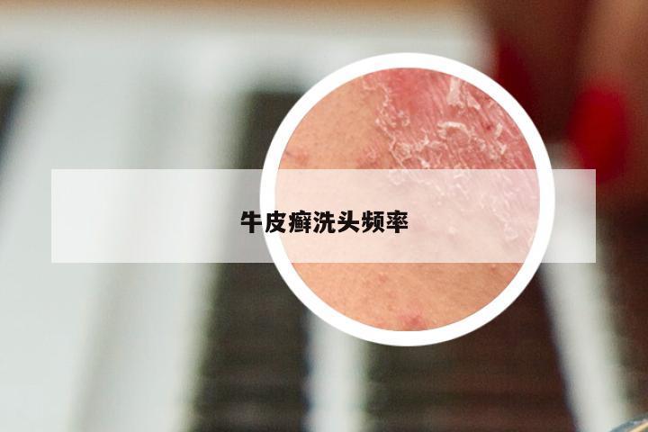 牛皮癣洗头频率