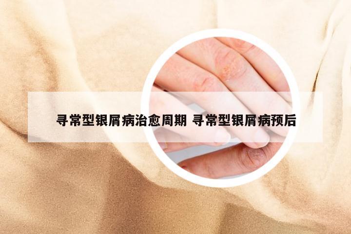 寻常型银屑病治愈周期 寻常型银屑病预后