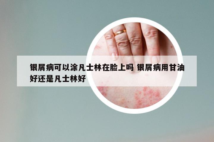 银屑病可以涂凡士林在脸上吗 银屑病用甘油好还是凡士林好