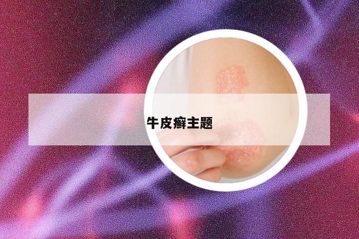 牛皮癣主题