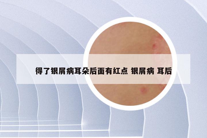 得了银屑病耳朵后面有红点 银屑病 耳后