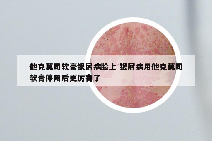 他克莫司软膏银屑病脸上 银屑病用他克莫司软膏停用后更厉害了