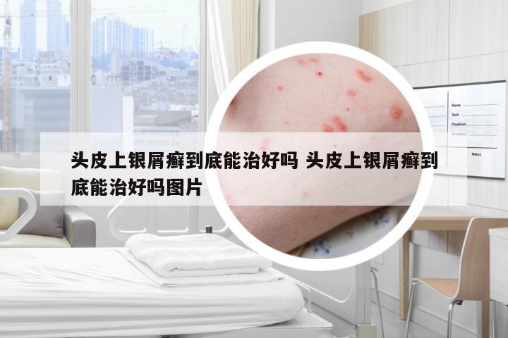 头皮上银屑癣到底能治好吗 头皮上银屑癣到底能治好吗图片