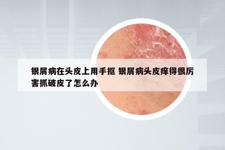 银屑病在头皮上用手抠 银屑病头皮痒得很厉害抓破皮了怎么办