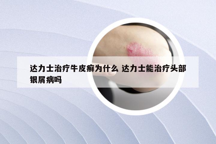 达力士治疗牛皮癣为什么 达力士能治疗头部银屑病吗