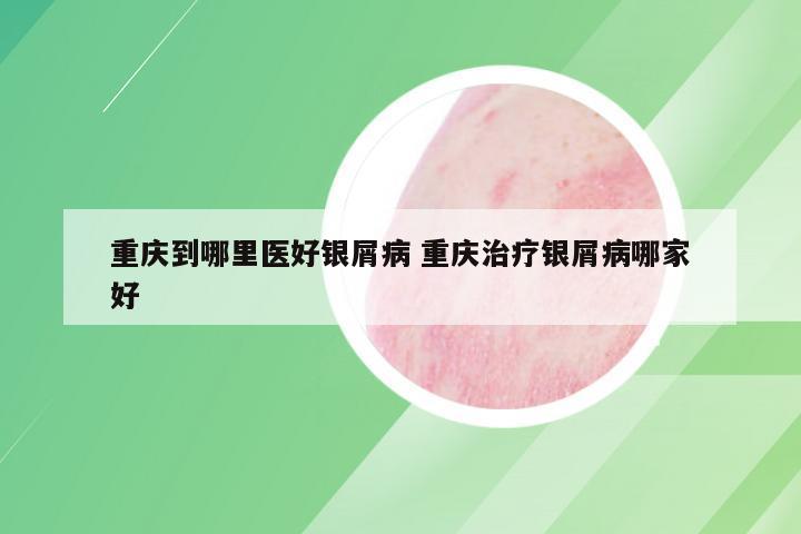 重庆到哪里医好银屑病 重庆治疗银屑病哪家好