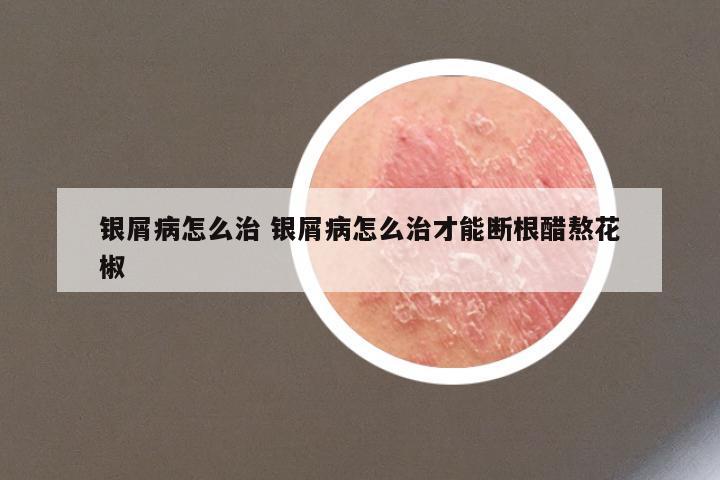 银屑病怎么治 银屑病怎么治才能断根醋熬花椒