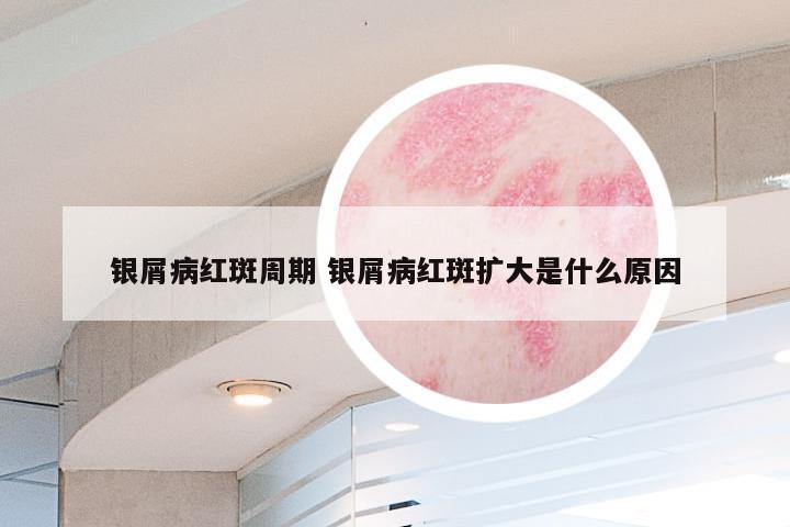 银屑病红斑周期 银屑病红斑扩大是什么原因
